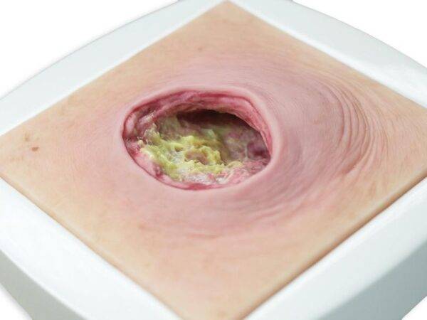 Das „Rahmenmodell Dekubitus mit glattem Wundrand" von MEDICAL FX Germany bietet eine exakte und realistische Darstellung eines Dekubitus mit charakteristisch glatten Wundrändern.…