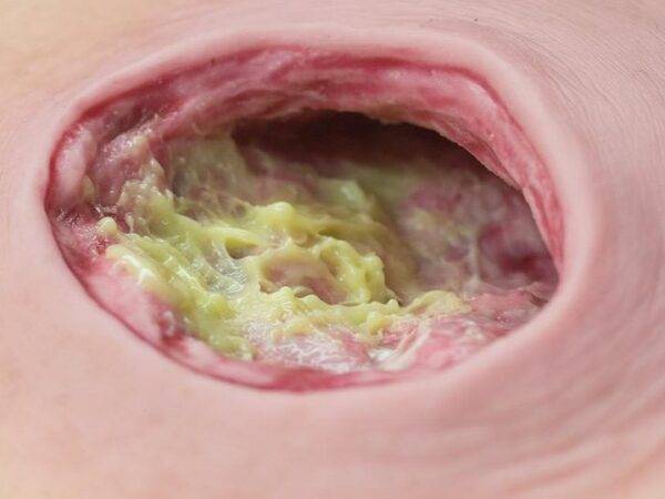 Das „Fibrinimitat“ von MEDICAL FX Germany zur Darstellung von Fibrinfaserstoff als Wundbelag auf künstlichen Wunden wurde eigens von uns entwickelt. Es kann auch für die Imitation…