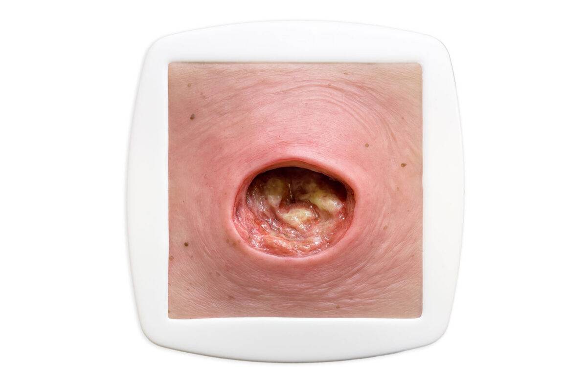 Das „Rahmenmodell Dekubitus mit glattem Wundrand" von MEDICAL FX Germany bietet eine exakte und realistische Darstellung eines Dekubitus mit charakteristisch glatten Wundrändern.…