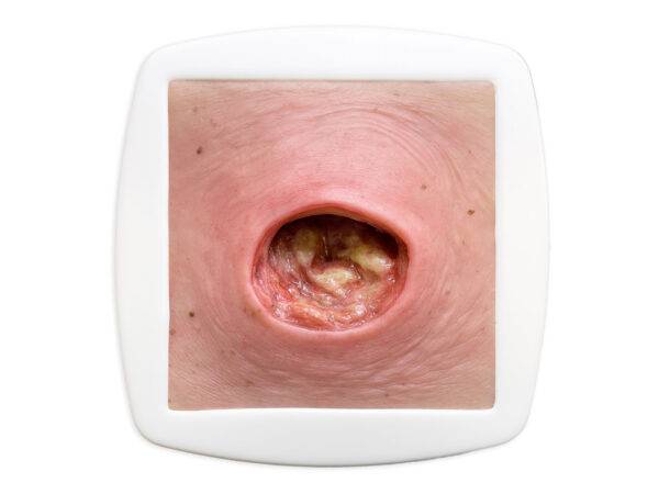 Das „Rahmenmodell Dekubitus mit glattem Wundrand" von MEDICAL FX Germany bietet eine exakte und realistische Darstellung eines Dekubitus mit charakteristisch glatten Wundrändern.…