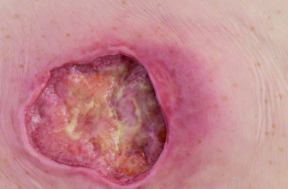 Das „Stick-On Medium Dekubitus Grad 3"-Modell von MEDICAL FX Germany ist eine detailgetreue Nachbildung einer Druckgeschwür-Wunde, wie sie im Stadium 3 auftritt. Eingebettet in ho…