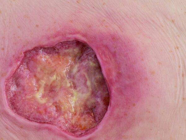 Das „Stick-On Medium Dekubitus Grad 3"-Modell von MEDICAL FX Germany ist eine detailgetreue Nachbildung einer Druckgeschwür-Wunde, wie sie im Stadium 3 auftritt. Eingebettet in ho…