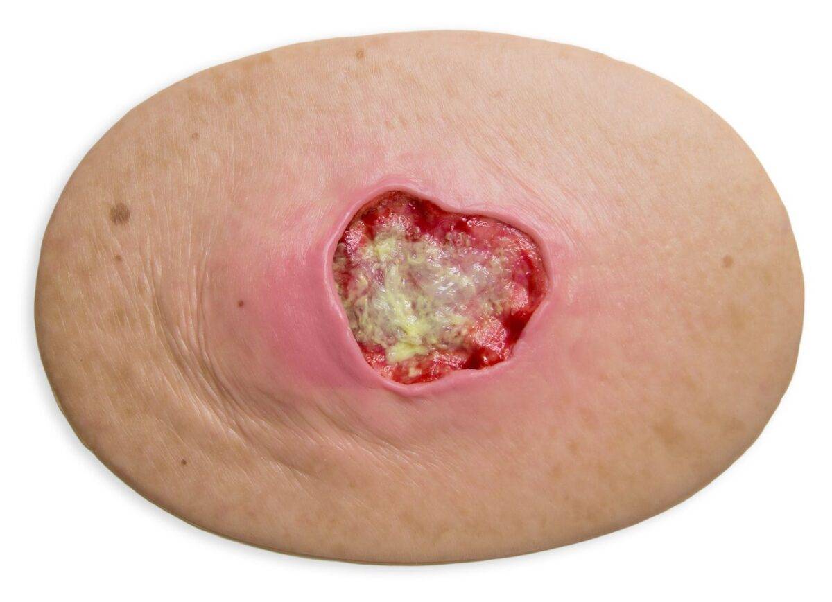 Das „Stick-On Medium Dekubitus Grad 3"-Modell von MEDICAL FX Germany ist eine detailgetreue Nachbildung einer Druckgeschwür-Wunde, wie sie im Stadium 3 auftritt. Eingebettet in ho…