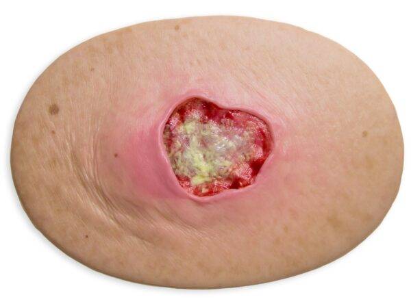 Das „Stick-On Medium Dekubitus Grad 3"-Modell von MEDICAL FX Germany ist eine detailgetreue Nachbildung einer Druckgeschwür-Wunde, wie sie im Stadium 3 auftritt. Eingebettet in ho…