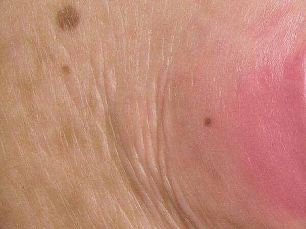 Das „Stick-On Medium Dekubitus Grad 3"-Modell von MEDICAL FX Germany ist eine detailgetreue Nachbildung einer Druckgeschwür-Wunde, wie sie im Stadium 3 auftritt. Eingebettet in ho…