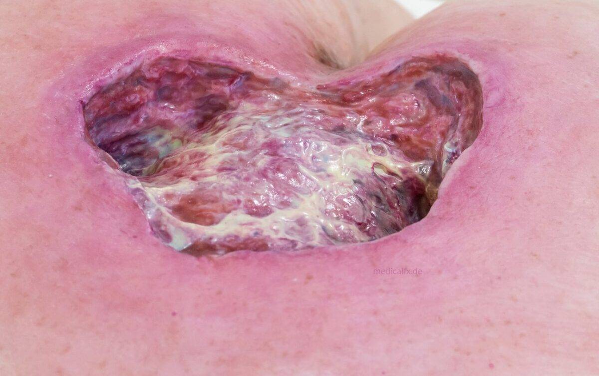 Das „Rahmenmodell Gesäß-Dekubitus" von MEDICAL FX Germany ist eine präzise Nachbildung eines fortgeschrittenen Druckgeschwürs im Sakralbereich, gefertigt aus hochwertigem Silikon.…