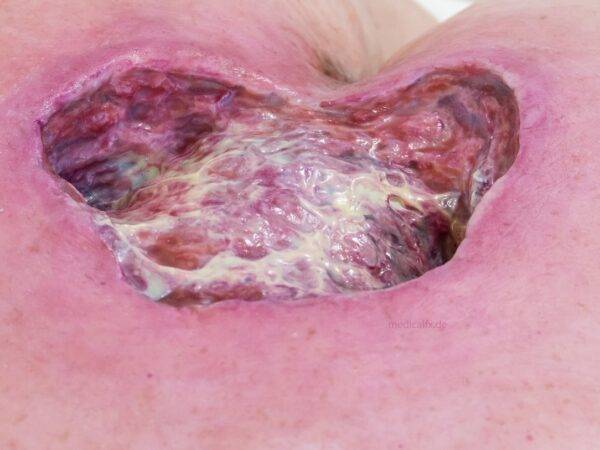 Das „Rahmenmodell Gesäß-Dekubitus" von MEDICAL FX Germany ist eine präzise Nachbildung eines fortgeschrittenen Druckgeschwürs im Sakralbereich, gefertigt aus hochwertigem Silikon.…