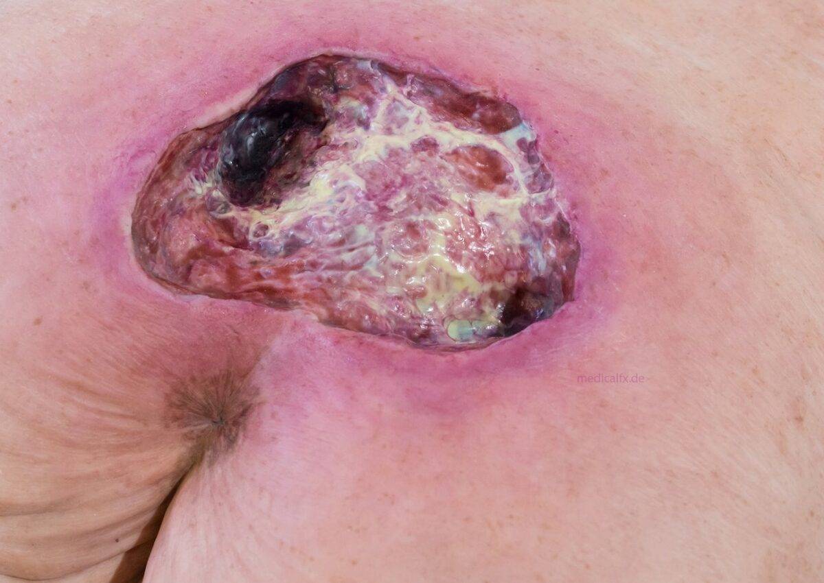 Das „Rahmenmodell Gesäß-Dekubitus" von MEDICAL FX Germany ist eine präzise Nachbildung eines fortgeschrittenen Druckgeschwürs im Sakralbereich, gefertigt aus hochwertigem Silikon.…