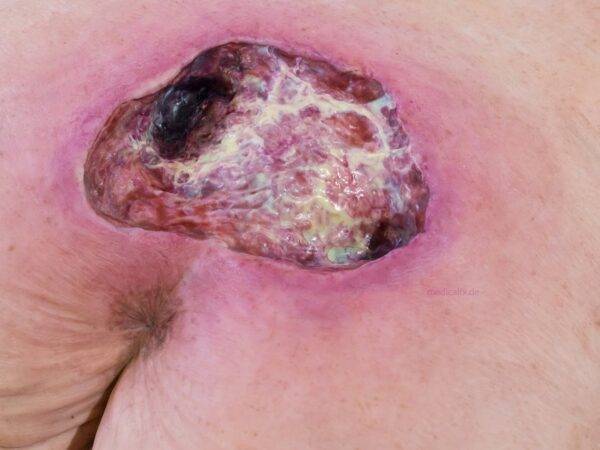 Das „Rahmenmodell Gesäß-Dekubitus" von MEDICAL FX Germany ist eine präzise Nachbildung eines fortgeschrittenen Druckgeschwürs im Sakralbereich, gefertigt aus hochwertigem Silikon.…