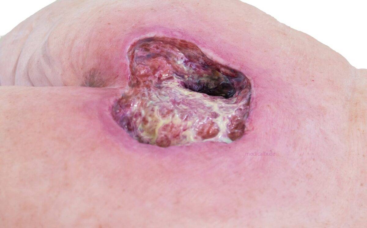 Das „Rahmenmodell Gesäß-Dekubitus" von MEDICAL FX Germany ist eine präzise Nachbildung eines fortgeschrittenen Druckgeschwürs im Sakralbereich, gefertigt aus hochwertigem Silikon.…