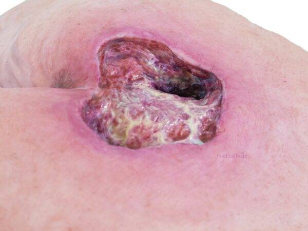 Das „Rahmenmodell Gesäß-Dekubitus" von MEDICAL FX Germany ist eine präzise Nachbildung eines fortgeschrittenen Druckgeschwürs im Sakralbereich, gefertigt aus hochwertigem Silikon.…