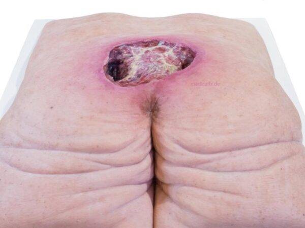 Das „Rahmenmodell Gesäß-Dekubitus" von MEDICAL FX Germany ist eine präzise Nachbildung eines fortgeschrittenen Druckgeschwürs im Sakralbereich, gefertigt aus hochwertigem Silikon.…