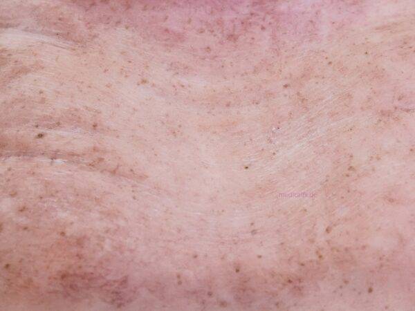 Das „Rahmenmodell Gesäß-Dekubitus" von MEDICAL FX Germany ist eine präzise Nachbildung eines fortgeschrittenen Druckgeschwürs im Sakralbereich, gefertigt aus hochwertigem Silikon.…