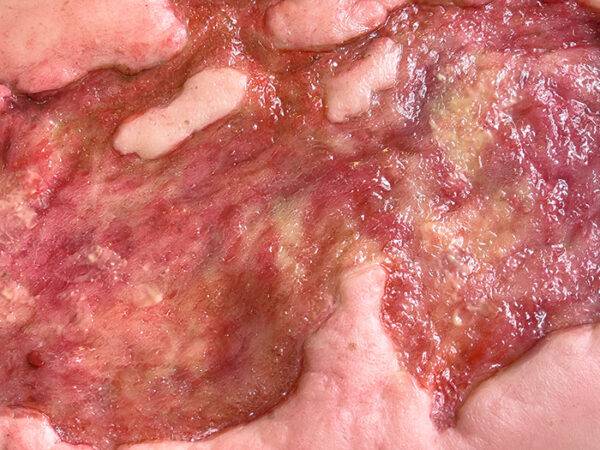 Das „Stick-On Large Ulcer mit Unterminierung"-Modell von MEDICAL FX Germany repräsentiert eine beeindruckende, lebensnahe Nachbildung eines großflächigen Ulcus mit charakteristisc…