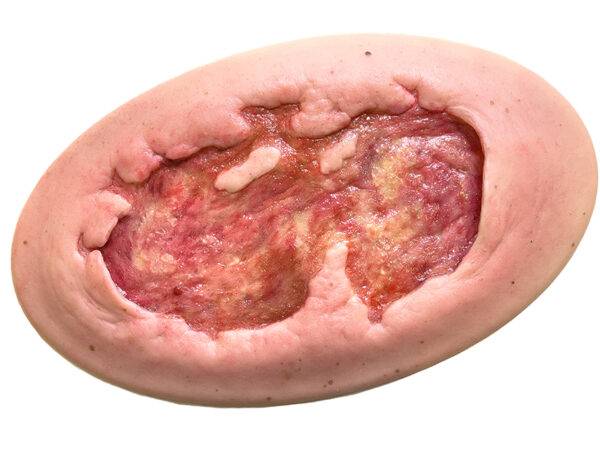 Das „Stick-On Large Ulcer mit Unterminierung"-Modell von MEDICAL FX Germany repräsentiert eine beeindruckende, lebensnahe Nachbildung eines großflächigen Ulcus mit charakteristisc…