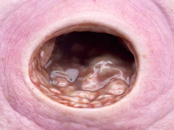 Das „Rahmenmodell Dekubitus mit glattem Wundrand" von MEDICAL FX Germany bietet eine exakte und realistische Darstellung eines Dekubitus mit charakteristisch glatten Wundrändern.…