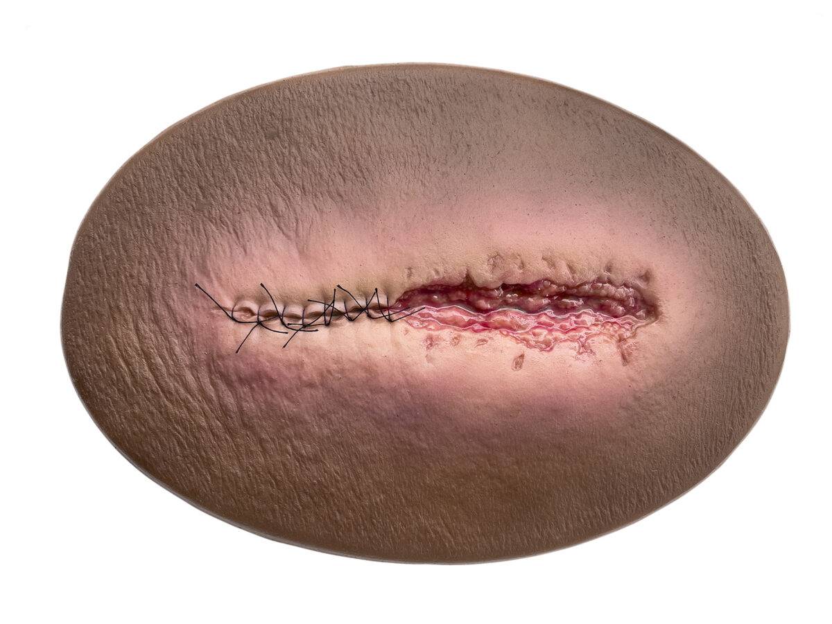 Das „Stick-On Medium OP Wunde, geöffnet"-Modell von MEDICAL FX Germany ist ein hochwertiges, mittelgroßes Silikonmodell zur Darstellung einer offenen Operationswunde. Es zeichnet…