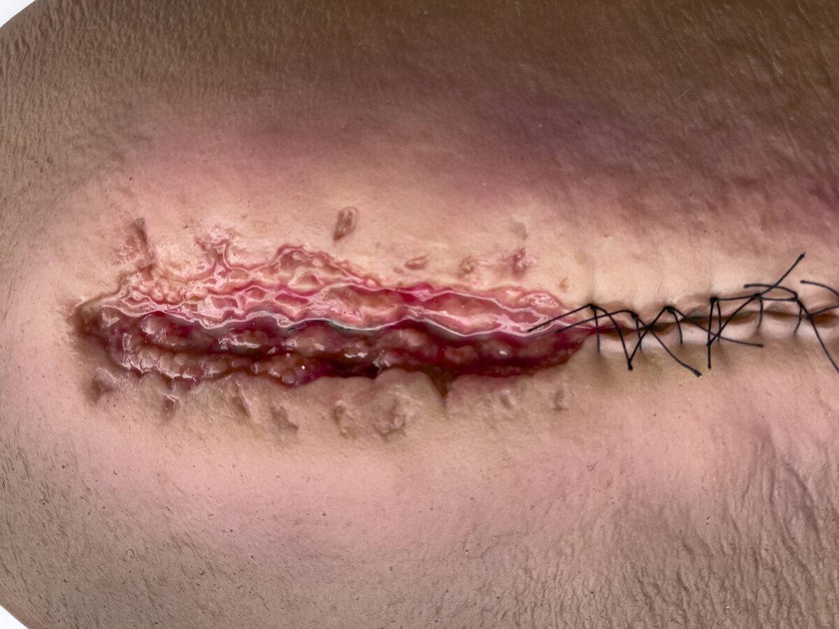 Das „Stick-On Medium OP Wunde, geöffnet"-Modell von MEDICAL FX Germany ist ein hochwertiges, mittelgroßes Silikonmodell zur Darstellung einer offenen Operationswunde. Es zeichnet…