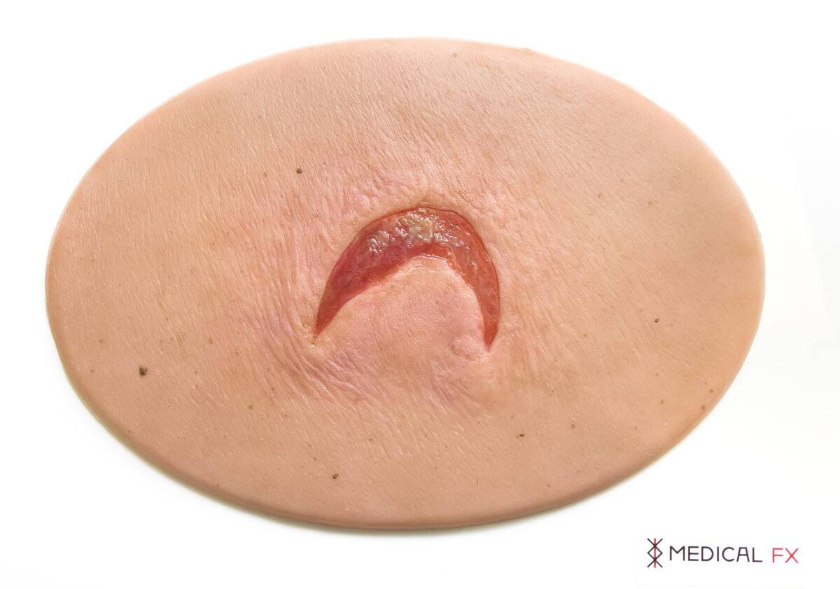 Das „Stick-On Medium Offene Ablederung" (Skin Tears)-Modell von MEDICAL FX Germany ist ein spezialisiertes, mittelgroßes Silikonmodell, das die Herausforderungen in der Behandlung…