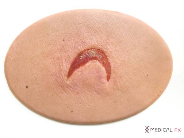 Das „Stick-On Medium Offene Ablederung" (Skin Tears)-Modell von MEDICAL FX Germany ist ein spezialisiertes, mittelgroßes Silikonmodell, das die Herausforderungen in der Behandlung…