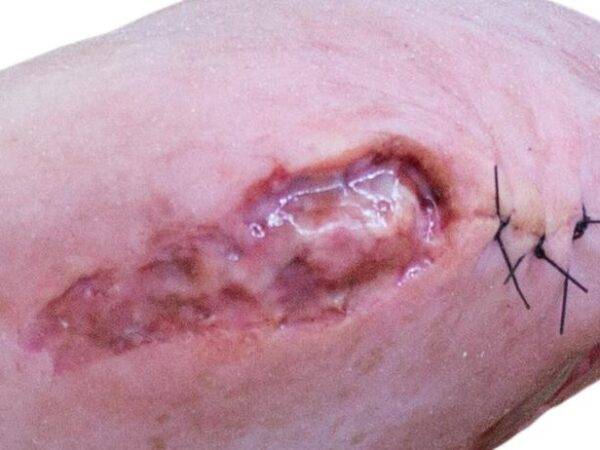 Das „Sockelmodell Zwei-Zehen-Fuß mit 6 Wunden“ von MEDICAL FX Germany präsentiert eine detailreiche Darstellung eines Fußes mit zwei verbliebenen Zehen und sechs verschiedenen Wun…