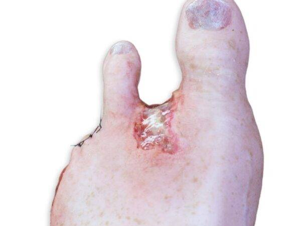 Das „Sockelmodell Zwei-Zehen-Fuß mit 6 Wunden“ von MEDICAL FX Germany präsentiert eine detailreiche Darstellung eines Fußes mit zwei verbliebenen Zehen und sechs verschiedenen Wun…