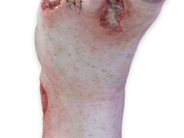 Das „Sockelmodell Zwei-Zehen-Fuß mit 6 Wunden“ von MEDICAL FX Germany präsentiert eine detailreiche Darstellung eines Fußes mit zwei verbliebenen Zehen und sechs verschiedenen Wun…