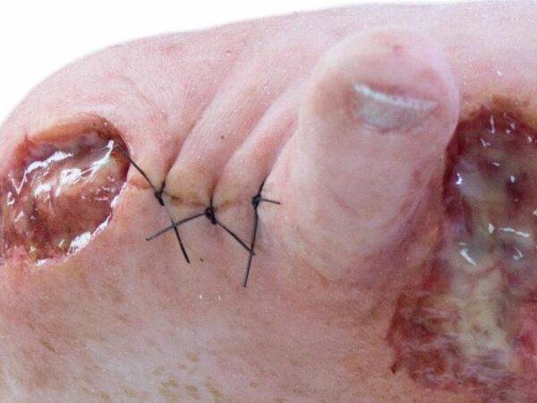 Das „Sockelmodell Zwei-Zehen-Fuß mit 6 Wunden“ von MEDICAL FX Germany präsentiert eine detailreiche Darstellung eines Fußes mit zwei verbliebenen Zehen und sechs verschiedenen Wun…