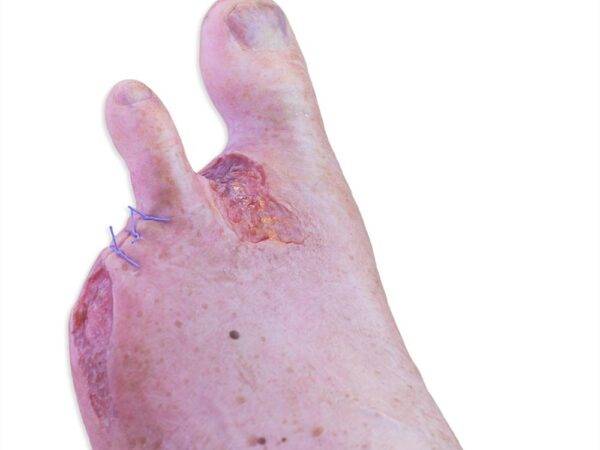 Das „Sockelmodell Zwei-Zehen-Fuß mit 6 Wunden“ von MEDICAL FX Germany präsentiert eine detailreiche Darstellung eines Fußes mit zwei verbliebenen Zehen und sechs verschiedenen Wun…