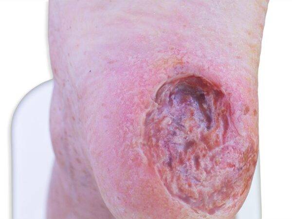 Das „Sockelmodell Zwei-Zehen-Fuß mit 6 Wunden“ von MEDICAL FX Germany präsentiert eine detailreiche Darstellung eines Fußes mit zwei verbliebenen Zehen und sechs verschiedenen Wun…