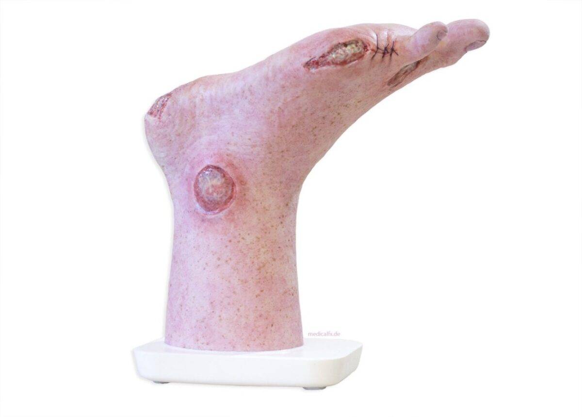 Das „Sockelmodell Zwei-Zehen-Fuß mit 6 Wunden“ von MEDICAL FX Germany präsentiert eine detailreiche Darstellung eines Fußes mit zwei verbliebenen Zehen und sechs verschiedenen Wun…