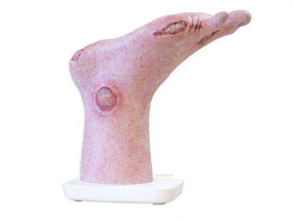 Das „Sockelmodell Zwei-Zehen-Fuß mit 6 Wunden“ von MEDICAL FX Germany präsentiert eine detailreiche Darstellung eines Fußes mit zwei verbliebenen Zehen und sechs verschiedenen Wun…