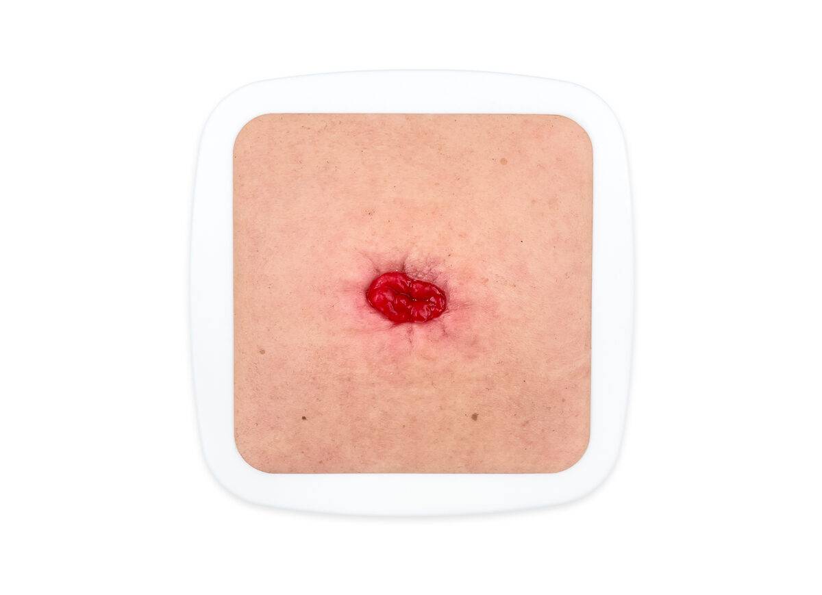 Das „Rahmenmodell Stoma in einer Mulde“ von MEDICAL FX Germany ist speziell dafür konzipiert, die Herausforderungen bei der Pflege und dem Management von Stomas zu veranschauliche…