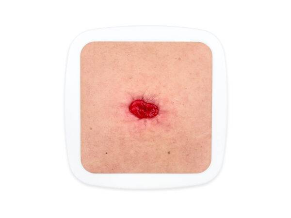 Das „Rahmenmodell Stoma in einer Mulde“ von MEDICAL FX Germany ist speziell dafür konzipiert, die Herausforderungen bei der Pflege und dem Management von Stomas zu veranschauliche…