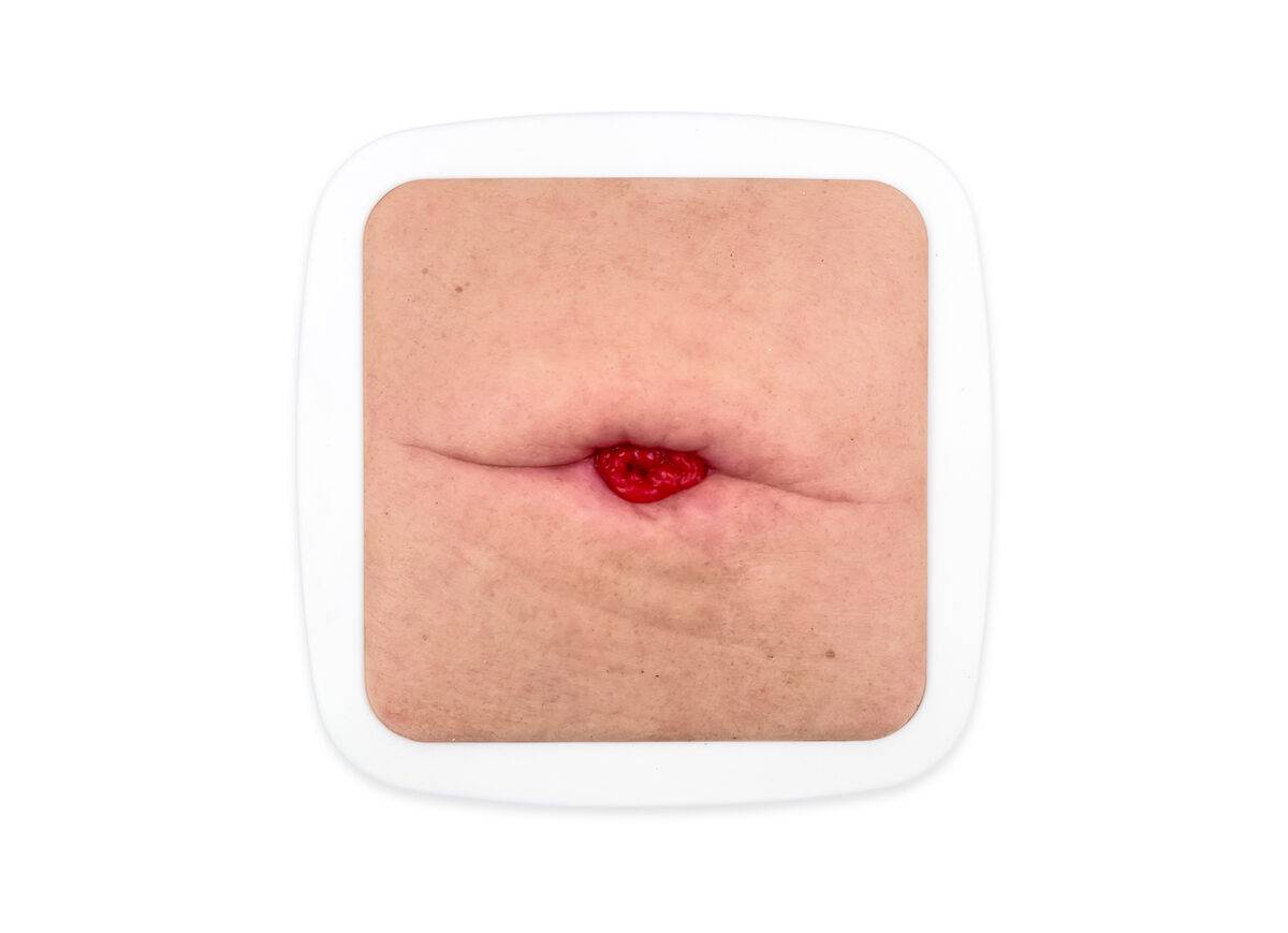 Das „Rahmenmodell Stoma in einer Hautfalte" von MEDICAL FX Germany illustriert ein Stoma, das in einer natürlichen oder durch Gewichtsveränderungen entstandenen Hautfalte platzier…