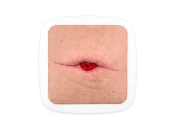 Das „Rahmenmodell Stoma in einer Hautfalte" von MEDICAL FX Germany illustriert ein Stoma, das in einer natürlichen oder durch Gewichtsveränderungen entstandenen Hautfalte platzier…