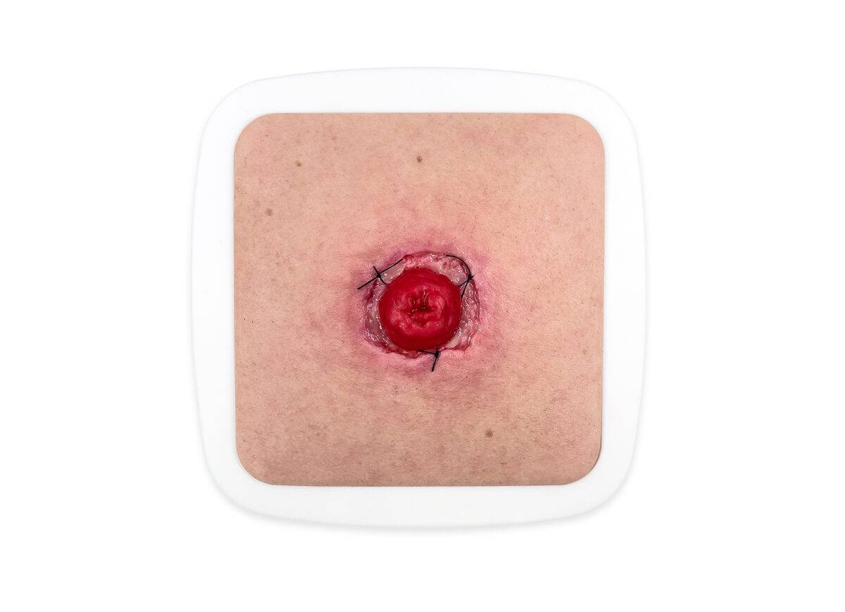 Das „Rahmenmodell Stoma mit Nahtdehiszenz" von MEDICAL FX Germany bietet eine hochpräzise Darstellung eines Stomas, bei dem eine Nahtdehiszenz aufgetreten ist. Dieses Modell ist i…