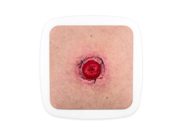 Das „Rahmenmodell Stoma mit Nahtdehiszenz" von MEDICAL FX Germany bietet eine hochpräzise Darstellung eines Stomas, bei dem eine Nahtdehiszenz aufgetreten ist. Dieses Modell ist i…