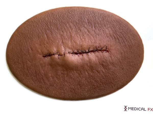 Das Modell „Stick-On Medium OP-Wunde Geschlossen und Entzündet" von MEDICAL FX Germany simuliert eine postoperative Wunde, die zwar geschlossen, aber entzündet ist. Dieses selbsth…