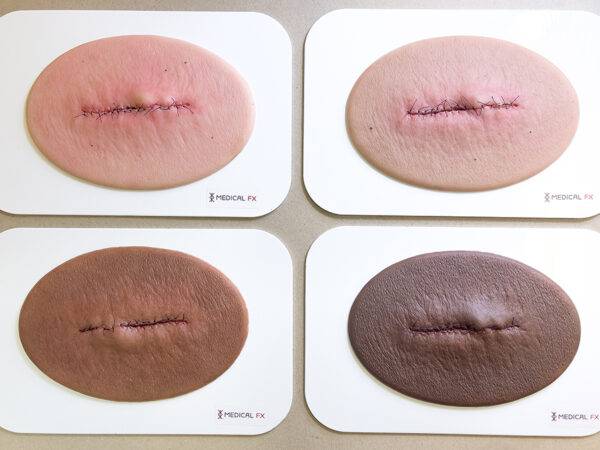 Das Modell „Stick-On Medium OP-Wunde Geschlossen und Entzündet" von MEDICAL FX Germany simuliert eine postoperative Wunde, die zwar geschlossen, aber entzündet ist. Dieses selbsth…