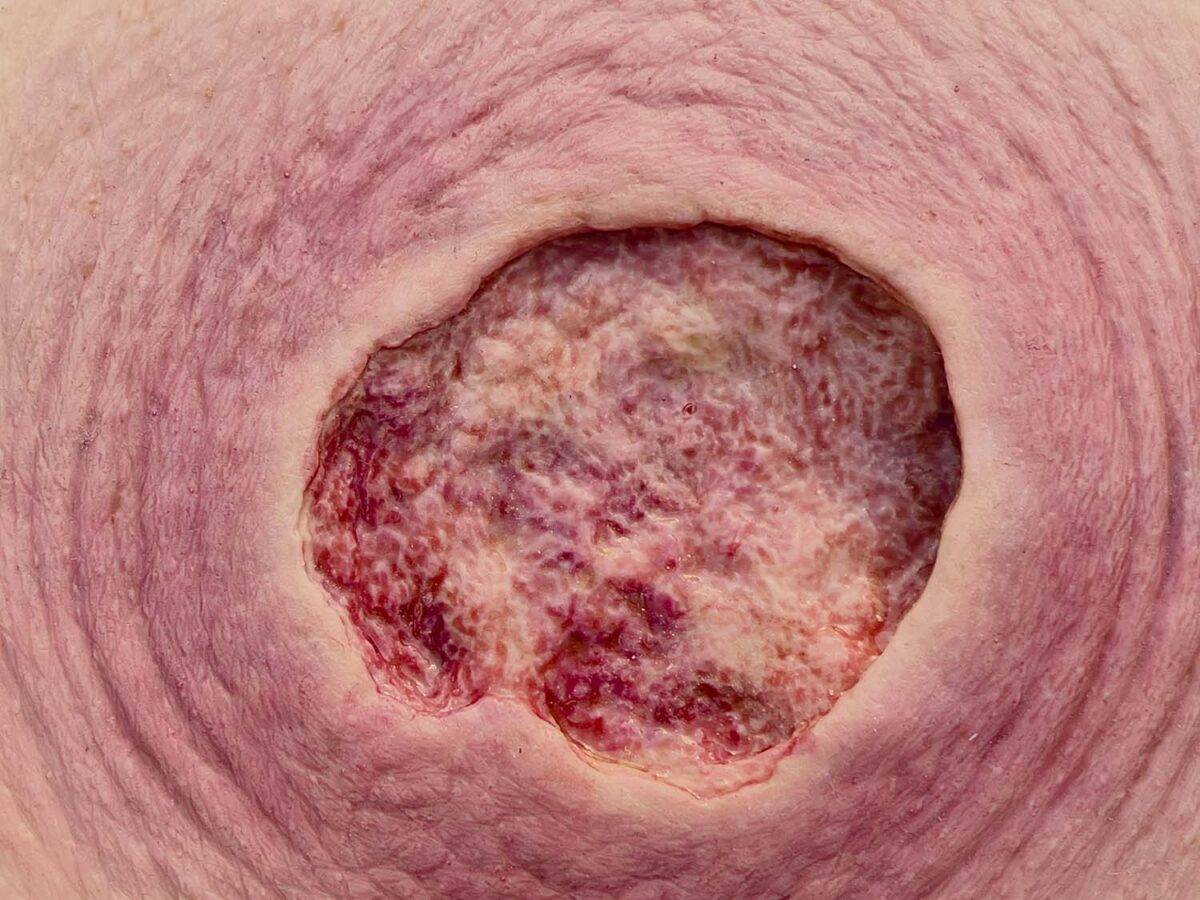 Das Modell „Stick-On Medium Ulcer mit Unterminierung“ von MEDICAL FX Germany bietet eine detaillierte Simulation eines mittelgroßen Ulcus mit unterminierten Wundrändern. Dieses se…