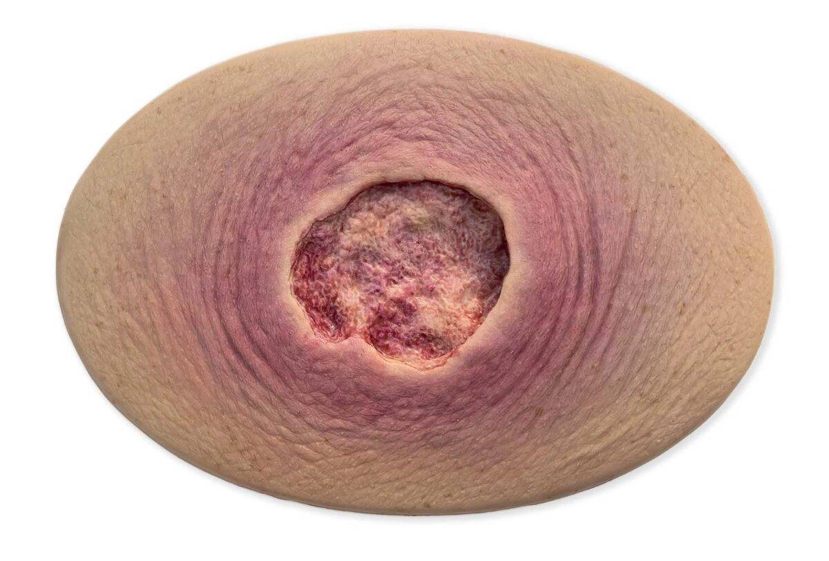 Das Modell „Stick-On Medium Ulcer mit Unterminierung“ von MEDICAL FX Germany bietet eine detaillierte Simulation eines mittelgroßen Ulcus mit unterminierten Wundrändern. Dieses se…