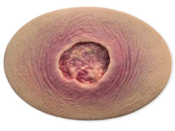 Das Modell „Stick-On Medium Ulcer mit Unterminierung“ von MEDICAL FX Germany bietet eine detaillierte Simulation eines mittelgroßen Ulcus mit unterminierten Wundrändern. Dieses se…