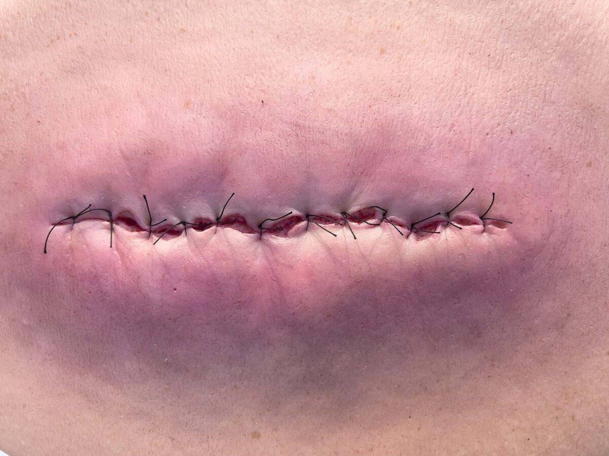 Das „Rahmenmodell OP-Wunde Geschlossen und Entzündet“ von MEDICAL FX Germany illustriert eine postoperative Wunde, die geschlossen ist, jedoch Anzeichen einer Entzündung zeigt. Ei…