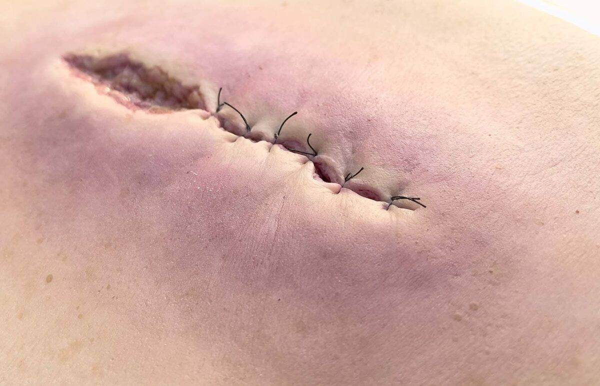 Das „Rahmenmodell OP-Wunde Geöffnet" von MEDICAL FX Germany bietet eine realistische Darstellung einer chirurgischen Wunde in geöffnetem Zustand. Dieses Modell ist in einen robust…