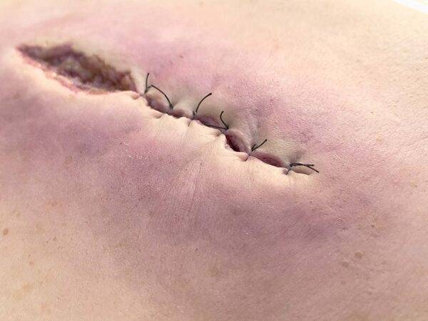 Das „Rahmenmodell OP-Wunde Geöffnet" von MEDICAL FX Germany bietet eine realistische Darstellung einer chirurgischen Wunde in geöffnetem Zustand. Dieses Modell ist in einen robust…