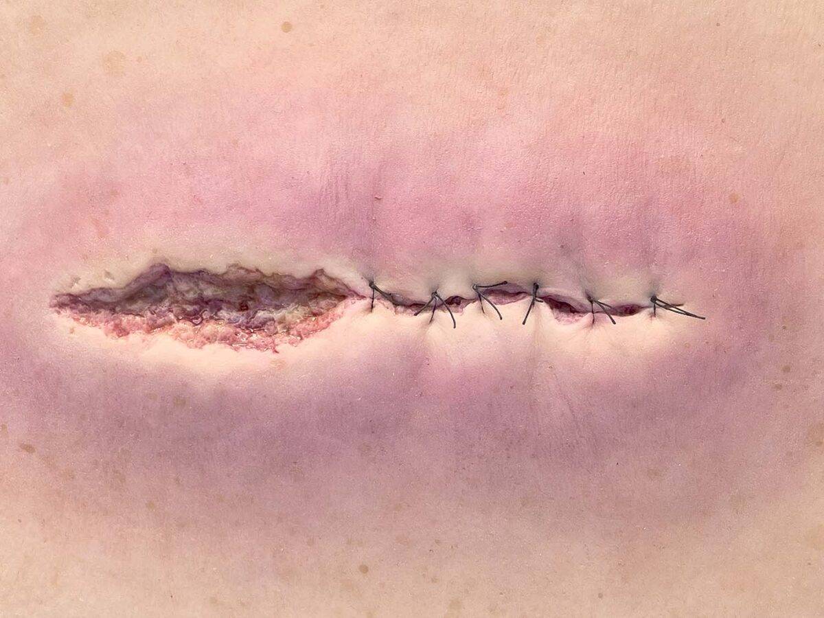 Das „Rahmenmodell OP-Wunde Geöffnet" von MEDICAL FX Germany bietet eine realistische Darstellung einer chirurgischen Wunde in geöffnetem Zustand. Dieses Modell ist in einen robust…