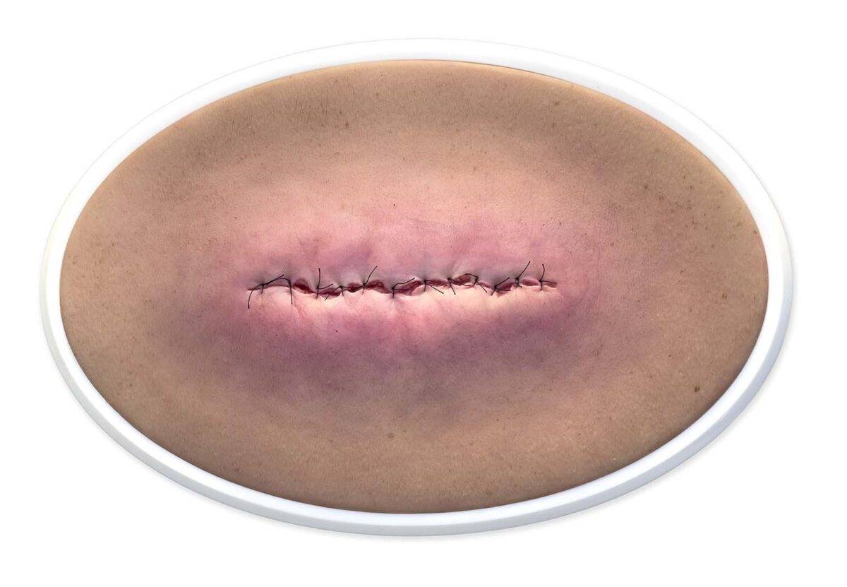 Das „Rahmenmodell OP-Wunde Geschlossen und Entzündet“ von MEDICAL FX Germany illustriert eine postoperative Wunde, die geschlossen ist, jedoch Anzeichen einer Entzündung zeigt. Ei…