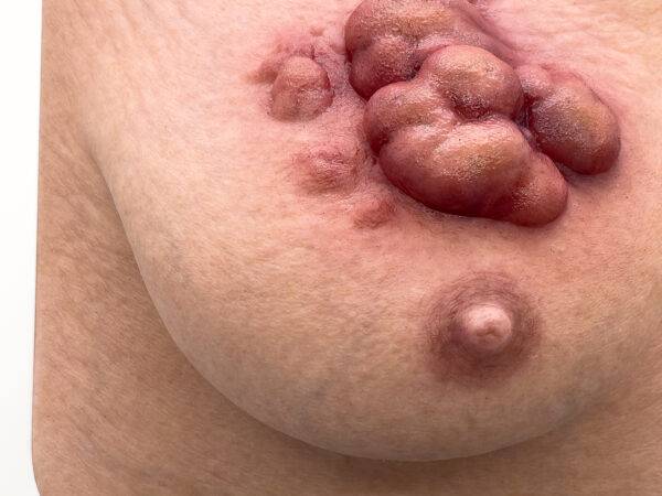 Das „Rahmenmodell Ulcerierendes Mamma-CA (Brusttumor)“ von MEDICAL FX Germany bietet eine detaillierte Darstellung eines ulcerierenden Brusttumors. Es ist in einen robusten, weiße…