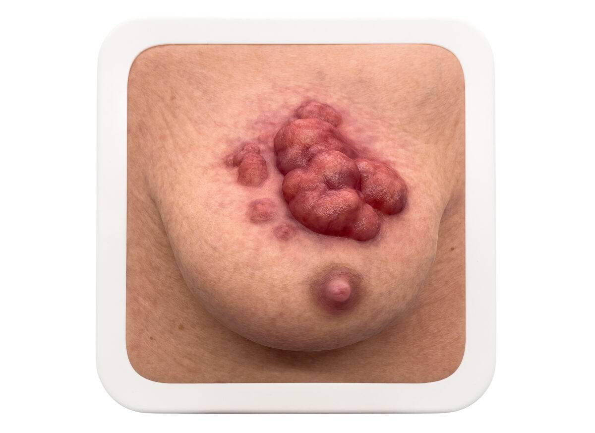 Das „Rahmenmodell Ulcerierendes Mamma-CA (Brusttumor)“ von MEDICAL FX Germany bietet eine detaillierte Darstellung eines ulcerierenden Brusttumors. Es ist in einen robusten, weiße…